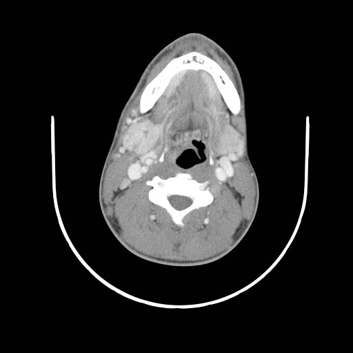 File:Acute submandibular sialadenitis secondary to ductal stone (Radiopaedia 27999-28267 Axial C+ delayed 25).jpg