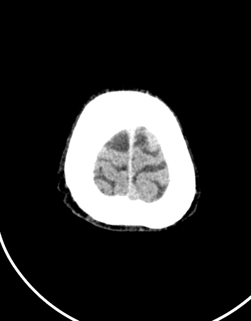 Acute superior cerebellar artery territory infarct (Radiopaedia 84104-99359 Axial non-contrast 11).jpg