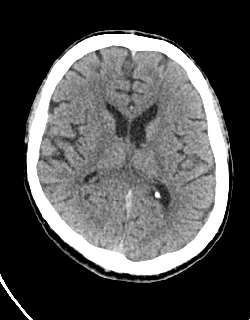 Acute superior cerebellar artery territory infarct (Radiopaedia 84104-99359 Axial non-contrast 33).jpg