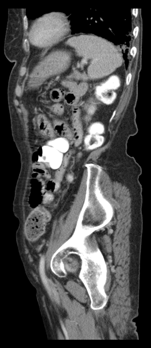 Adenocarcinoma of cecum (Radiopaedia 59222-66549 Sagittal C+ portal venous phase 16).jpg