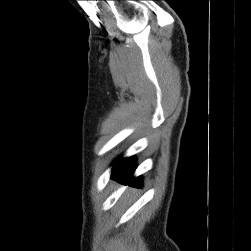 Adenocarcinoma of the lung (Radiopaedia 59871-67325 Sagittal C+ arterial phase 1).jpg