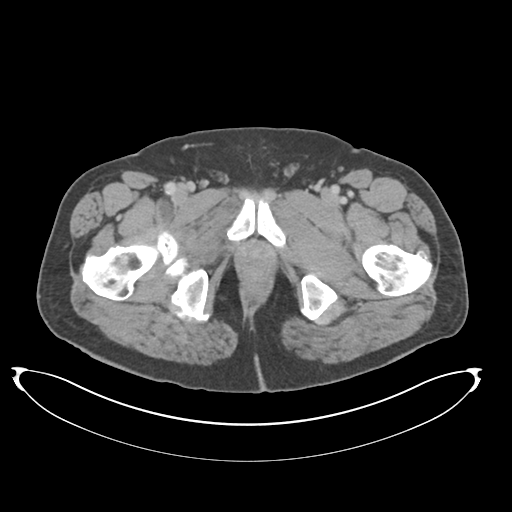Adenocarcioma of rectum- T1 lesion (Radiopaedia 36921-38547 Axial C+ portal venous phase 92).png