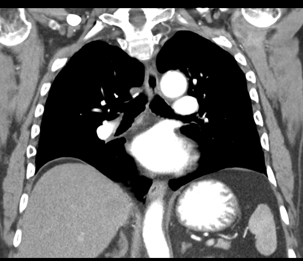 Adenocarcioma of rectum- T1 lesion (Radiopaedia 36921-38547 Coronal C+ arterial phase 37).png