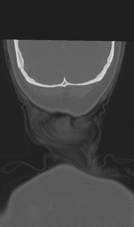Adenoid cystic tumor of palate (Radiopaedia 46980-51518 Coronal bone window 60).png