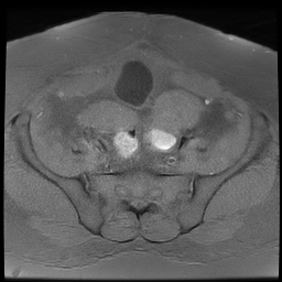 File:Adenomyosis within a didelphys uterus (Radiopaedia 70175-80215 Axial T1 fat sat 19).jpg