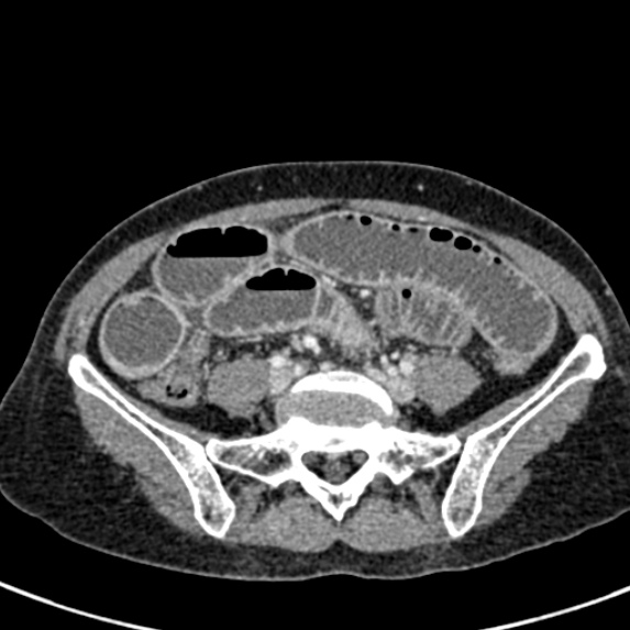 Adhesional small bowel obstruction (Radiopaedia 48397-53305 Axial C+ portal venous phase 62).jpg