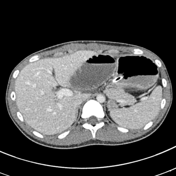 Adhesional small bowel obstruction (Radiopaedia 52107-57980 Axial C+ portal venous phase 23).jpg
