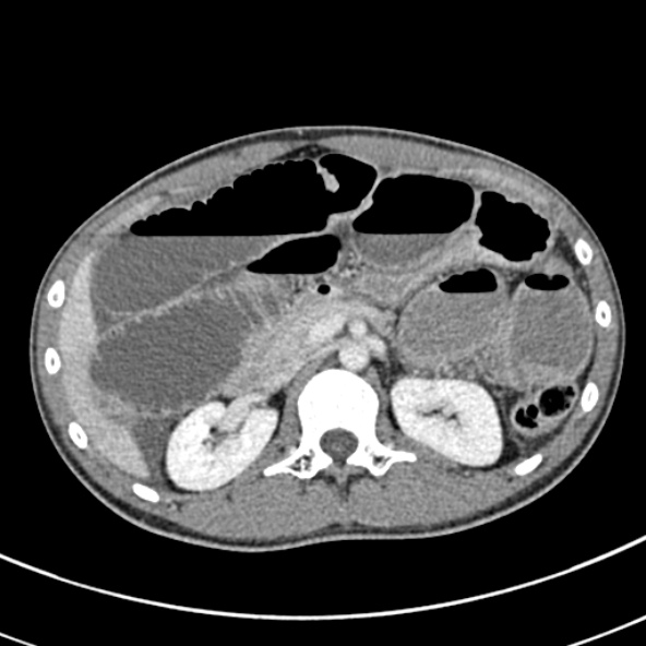 File:Adhesional small bowel obstruction (Radiopaedia 52107-57980 Axial C+ portal venous phase 38).jpg