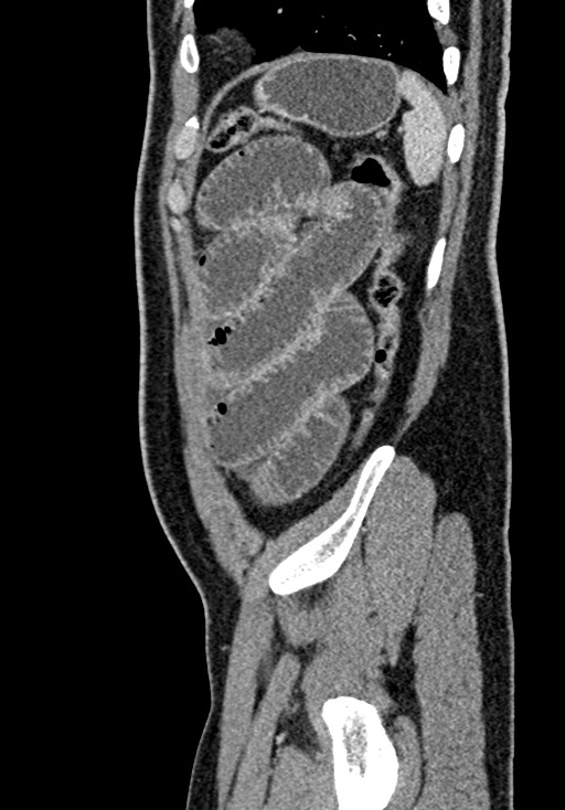 Adhesional small bowel obstruction (Radiopaedia 58900-66131 Sagittal C+ portal venous phase 211).jpg