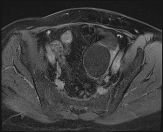 File:Adnexal multilocular cyst (O-RADS US 3. O-RADS MRI 3) (Radiopaedia 87426-103754 Axial 247).jpeg