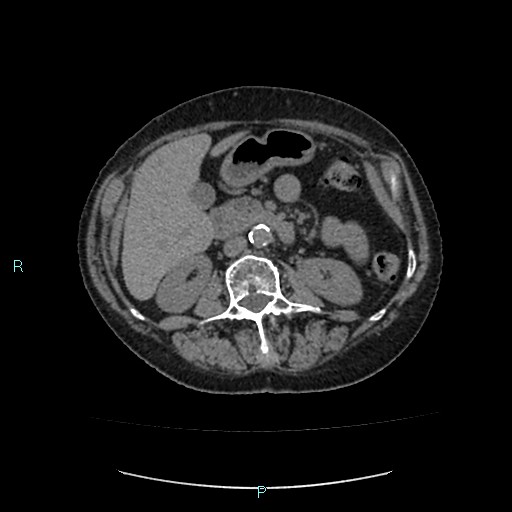 File:Adrenal collision tumor (ACT) (Radiopaedia 48462-53379 Axial non-contrast 26).jpg