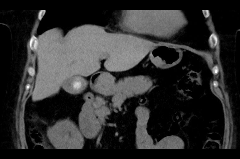 Adrenal cortical carcinoma (Radiopaedia 64017-72769 Coronal non-contrast 20).jpg
