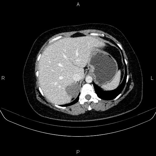 Adrenal cortical carcinoma (Radiopaedia 84882-100379 Axial C+ portal venous phase 16).jpg