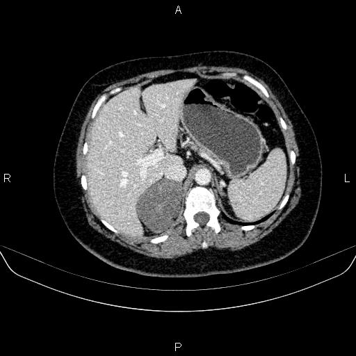 Adrenal cortical carcinoma (Radiopaedia 84882-100379 Axial C+ portal venous phase 22).jpg