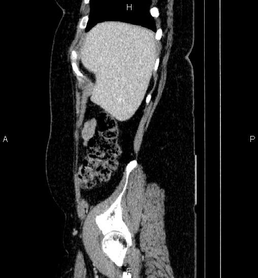 Adrenal cortical carcinoma (Radiopaedia 84882-100379 Sagittal C+ portal venous phase 13).jpg