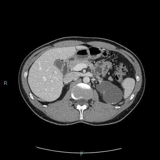 File:Adrenal cystic lymphangioma (Radiopaedia 83161-97534 Axial C+ portal venous phase 32).jpg