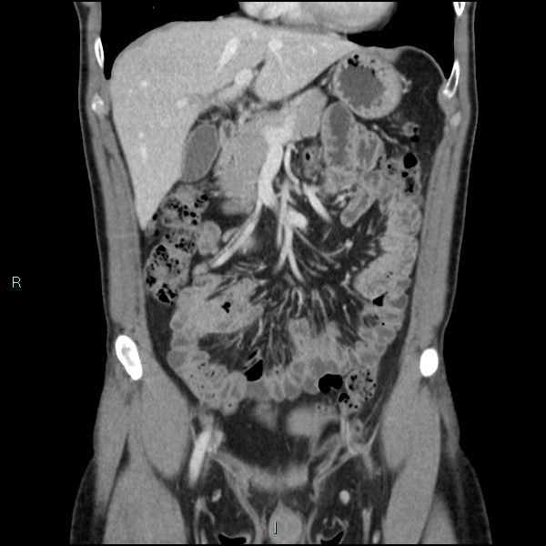 Adrenal cystic lymphangioma (Radiopaedia 83161-97534 Coronal C+ portal venous phase 26).jpg