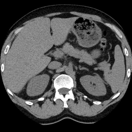 File:Adrenal gland trauma (Radiopaedia 81351-95079 Axial non-contrast 34).jpg