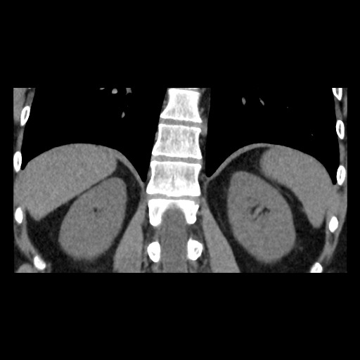 Adrenal gland trauma (Radiopaedia 81351-95079 Coronal non-contrast 65).jpg