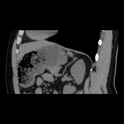 Adrenal gland trauma (Radiopaedia 81351-95079 Sagittal non-contrast 67).jpg