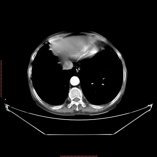 Adrenal hemangioma (Radiopaedia 68923-78668 Axial C+ arterial phase 15).jpg