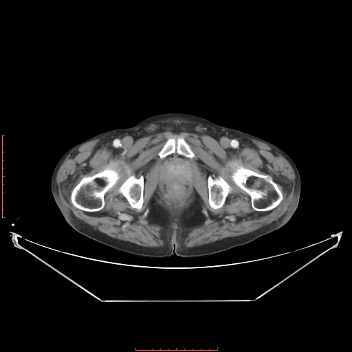 File:Adrenal hemangioma (Radiopaedia 68923-78668 Axial C+ portal venous phase 72).jpg