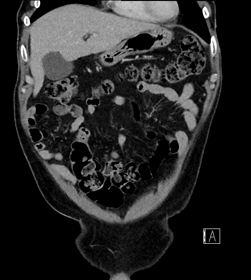 Adrenal lymphoma (Radiopaedia 73730-84529 Coronal C+ portal venous phase 20).jpg