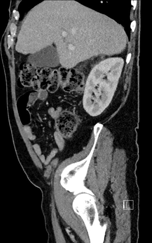 Adrenal lymphoma (Radiopaedia 73730-84529 Sagittal C+ portal venous phase 28).jpg