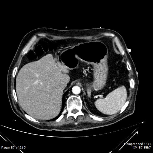 File:Adrenal metastasis (Radiopaedia 78425-91079 Axial C+ arterial phase 17).jpg