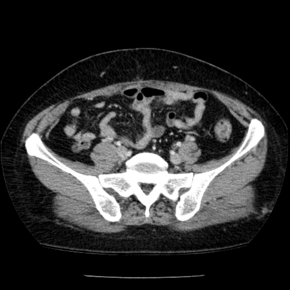 Adrenal myelolipoma (Radiopaedia 43401-46759 Axial C+ portal venous phase 64).jpg