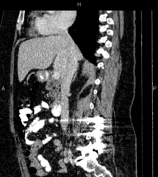 Adrenal myelolipoma (Radiopaedia 84319-99617 Sagittal renal cortical phase 40).jpg