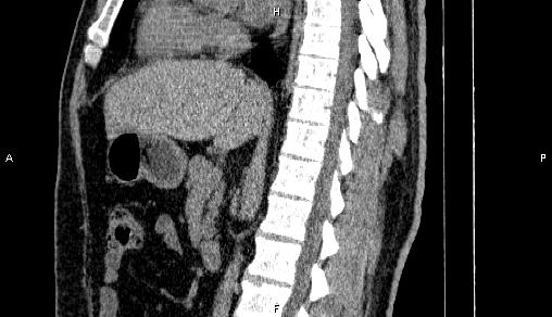 File:Adrenal myelolipoma (Radiopaedia 84321-99619 Sagittal non-contrast 54).jpg