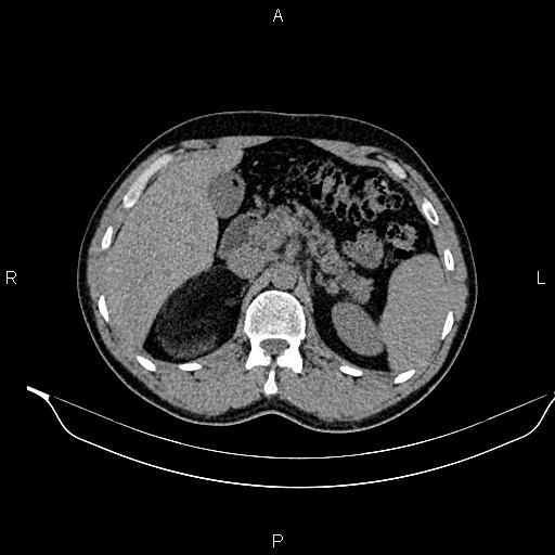 Adrenal myelolipoma (Radiopaedia 87794-104246 Axial non-contrast 36).jpg
