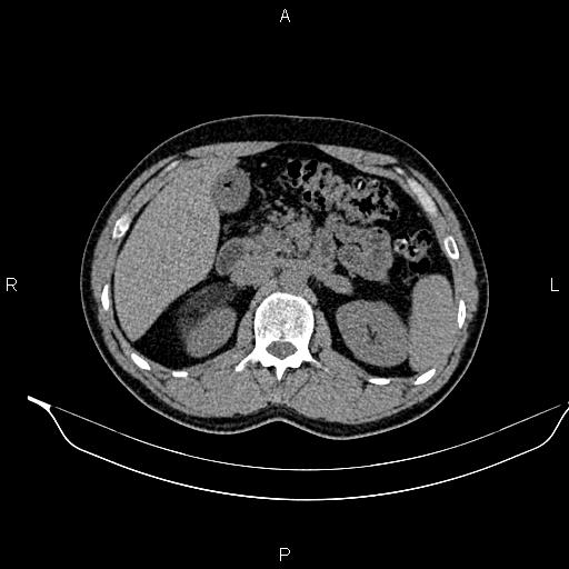 Adrenal myelolipoma (Radiopaedia 87794-104246 Axial non-contrast 39).jpg