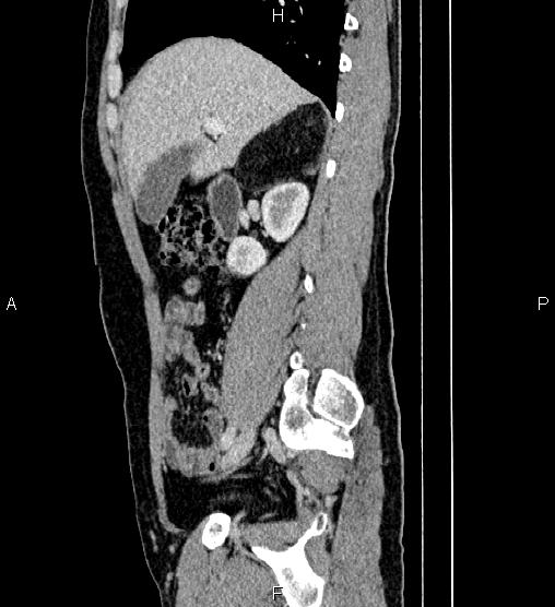 Adrenal myelolipoma (Radiopaedia 87794-104246 Sagittal renal cortical phase 32).jpg