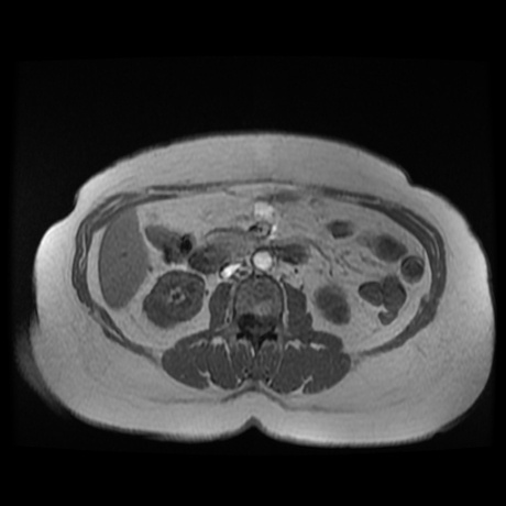 File:Adrenal myelolipoma - MRI (Radiopaedia 83249-97646 Axial T1-in phase 19).jpg