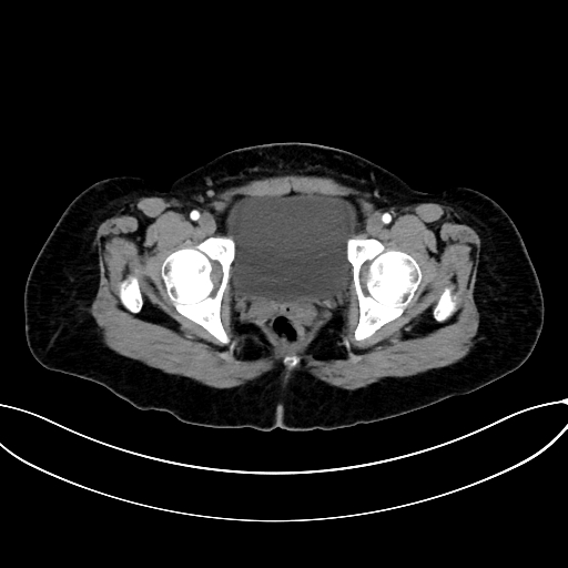 Adrenocortical carcinoma (Radiopaedia 87281-103569 Axial C+ arterial phase 84).jpg