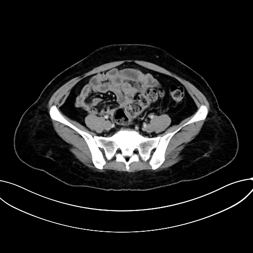 File:Adrenocortical carcinoma (Radiopaedia 87281-103569 Axial C+ portal venous phase 64).jpg