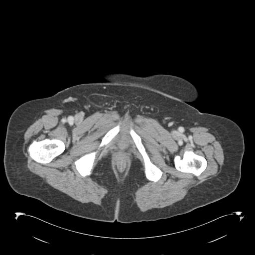 Adult ileal intussusception with secondary obstruction (Radiopaedia 30395-31051 Axial C+ portal venous phase 83).jpg