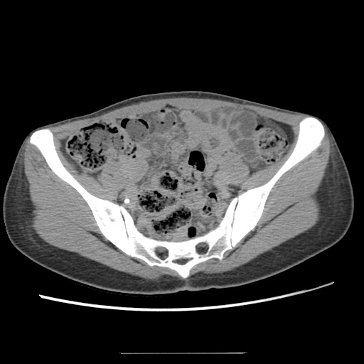 File:Adult polycystic kidney disease (Radiopaedia 48845-53876 Axial renal excretory phase 74).jpg