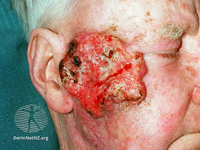 File:Advanced squamous cell carcinoma (DermNet NZ scc-0009).jpg