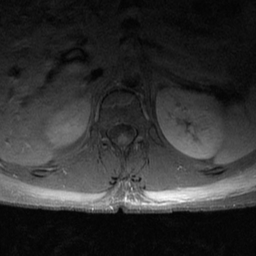 File:Aggressive vertebral hemangioma (Radiopaedia 39937-42404 Axial T1 C+ fat sat 5).png