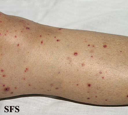 Allergic Vasculitis (Dermatology Atlas 13).jpg