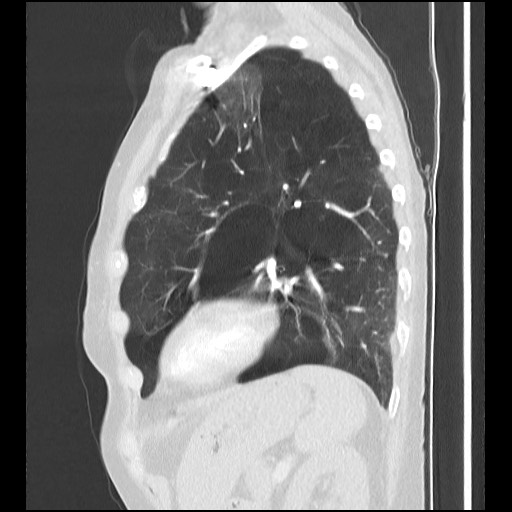 Alpha-1-antitrypsin deficiency (Radiopaedia 64893-73840 Sagittal lung window 41).jpg