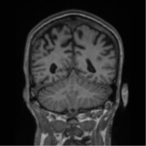 File:Alzheimer's disease- with apraxia (Radiopaedia 54763-61011 Coronal T1 32).png