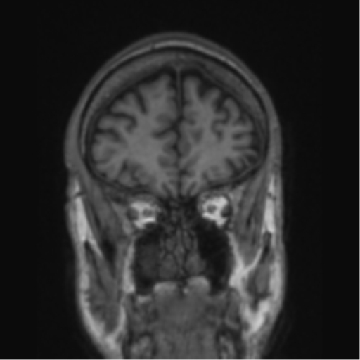 File:Alzheimer's disease- with apraxia (Radiopaedia 54763-61011 Coronal T1 73).png