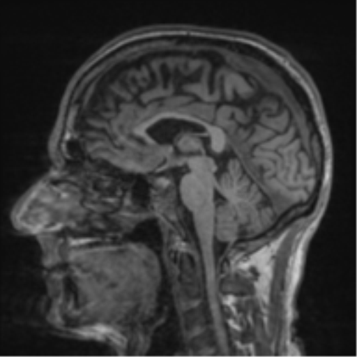 File:Alzheimer's disease- with apraxia (Radiopaedia 54763-61011 Sagittal T1 34).png