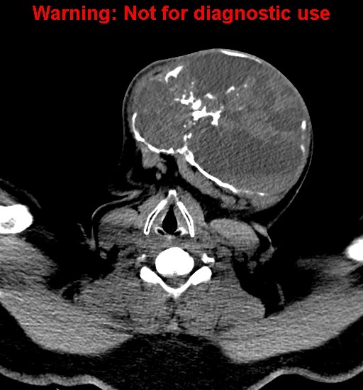 File:Ameloblastoma (Radiopaedia 33126-34164 A 25).jpg