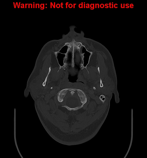 Ameloblastoma (Radiopaedia 33126-34164 Axial bone window 2).jpg