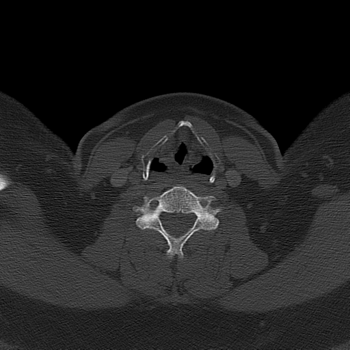Ameloblastoma (Radiopaedia 38520-40623 Axial bone window 52).png